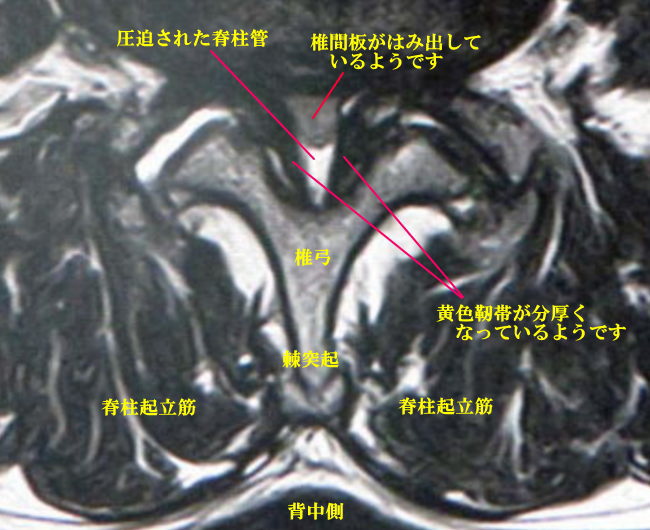 脊柱管の周囲