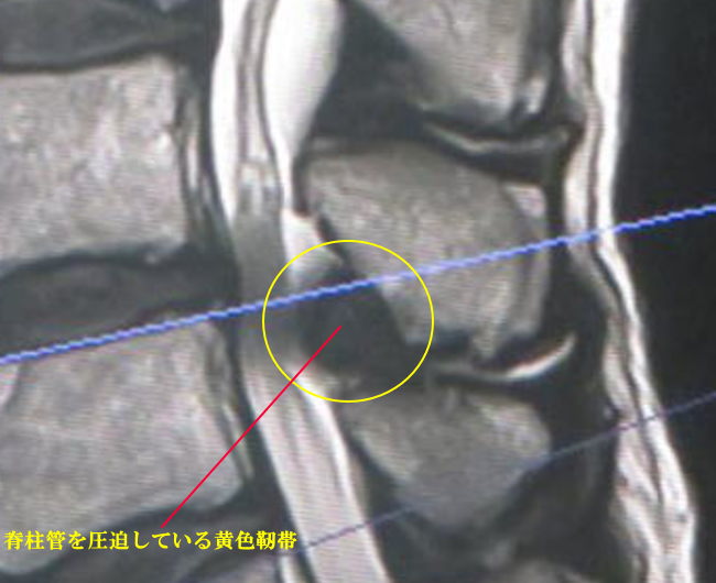 脊柱管の周囲