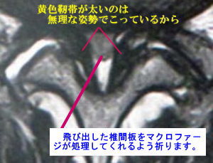 黄色靭帯