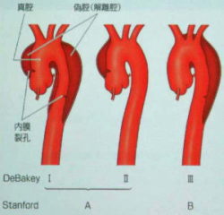 大動脈解離の位置