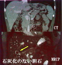 石灰化のない胆石