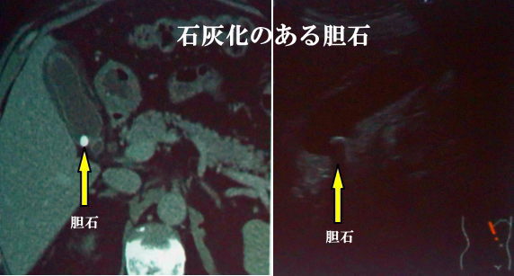 石灰化のある胆石