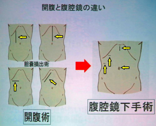 開腹と腹腔鏡の違い