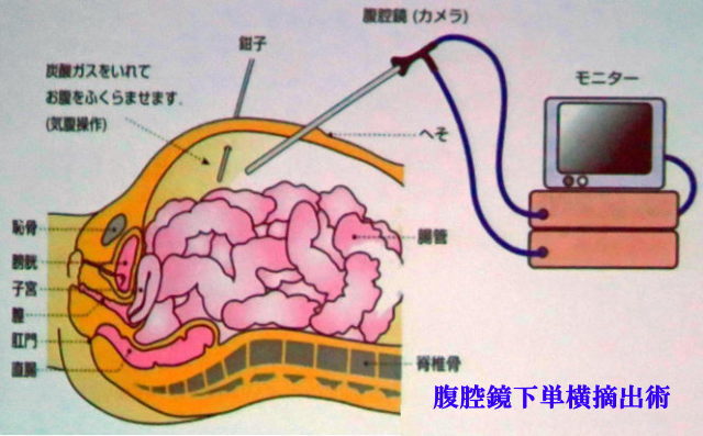 開腹と腹腔鏡の違い