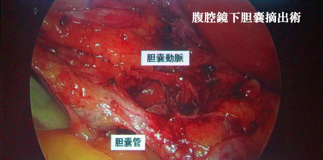 腹腔鏡下胆嚢摘出術