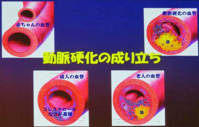 動脈硬化の過程