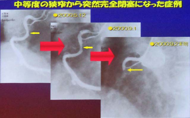 動脈硬化の進行