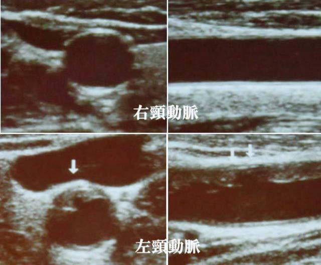 頸動脈の状態