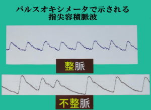 指尖容積脈波